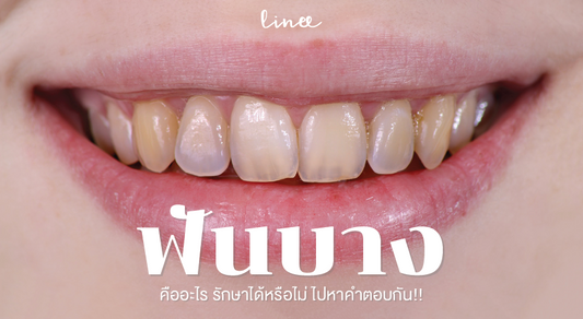 อาการ "ฟันบาง" คืออะไร รักษาได้หรือไม่ ไปหาคำตอบกัน