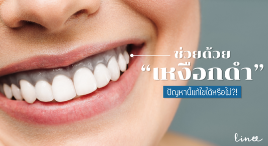ช่วยด้วย เหงือกดำ ปัญหาขำไม่ออกแบบนี้แก้ไขอย่างไรดี ?!